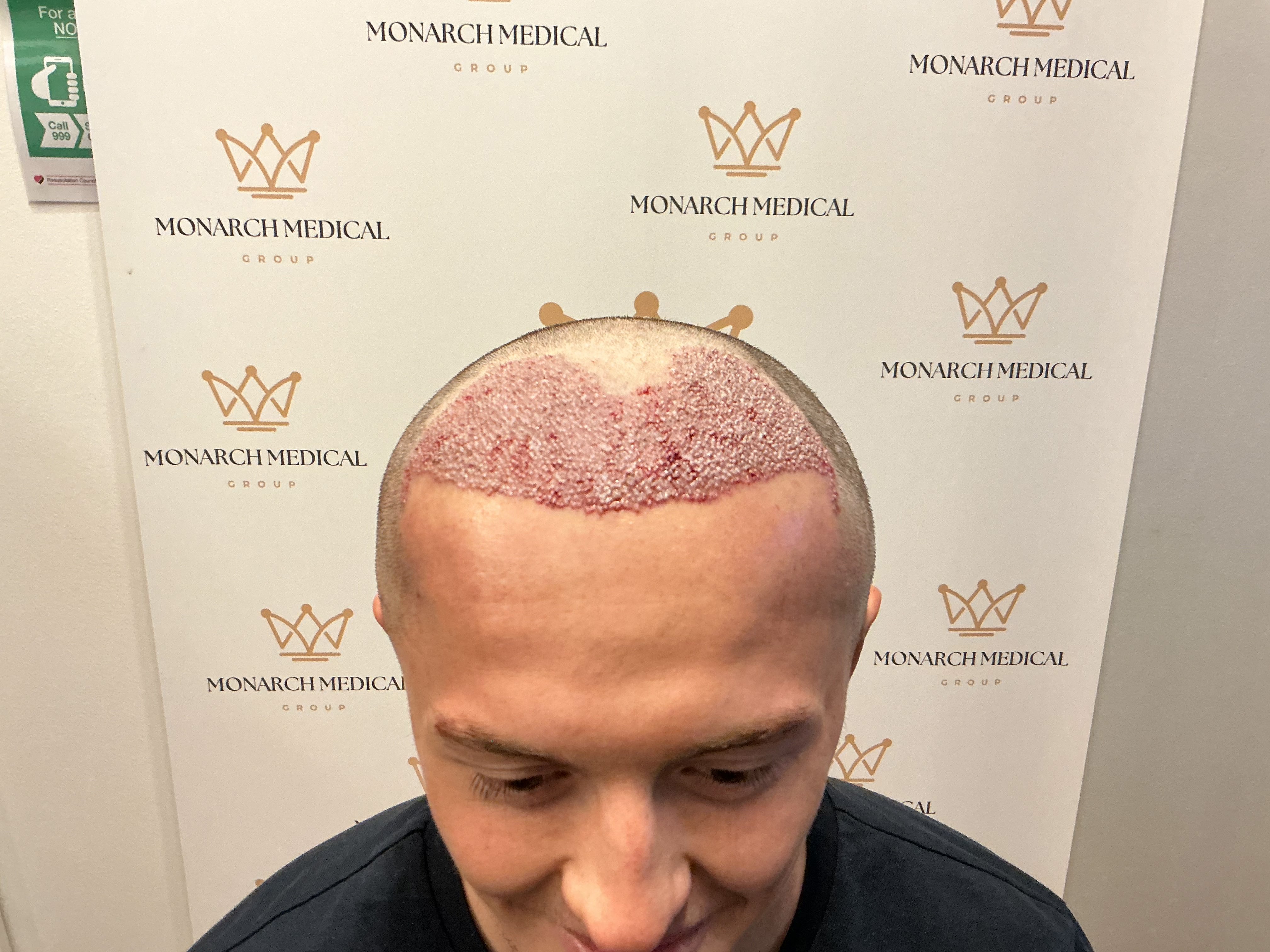 Advanced hairline recession — result photo 6